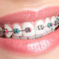 Braces vs Clear Aligners: Orthodontic Treatment Is More Affordable Than You Think